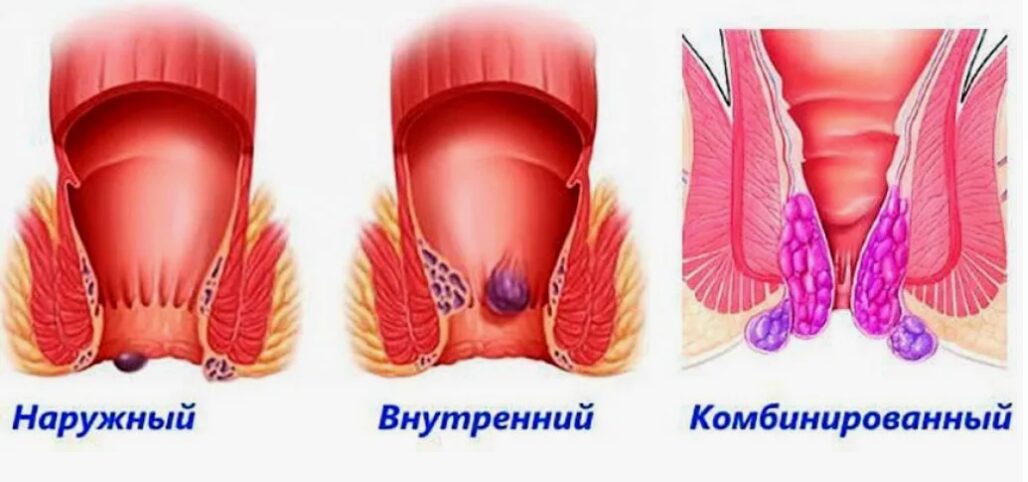 Геморроидальная патология